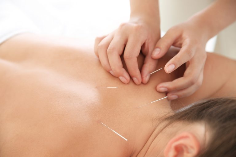 Acupuncture — Eastgate Physiotherapy, Sherwood Park